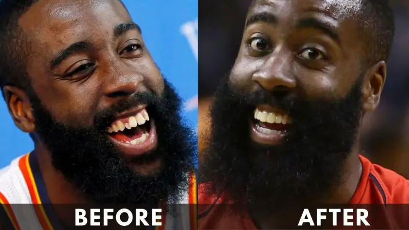 James-Harden-Before-and-after-Teeth