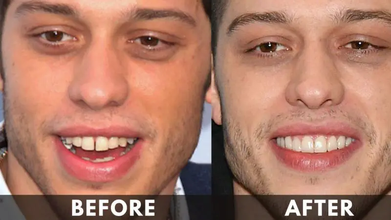 Pete Davidson Teeth Before And After