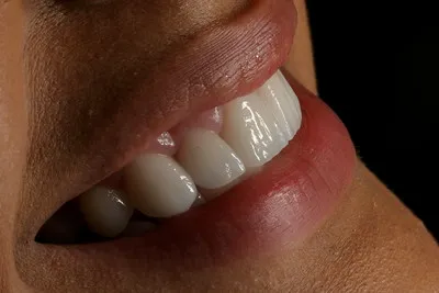 Veneers teeth