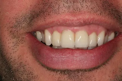 Teeth after veneers