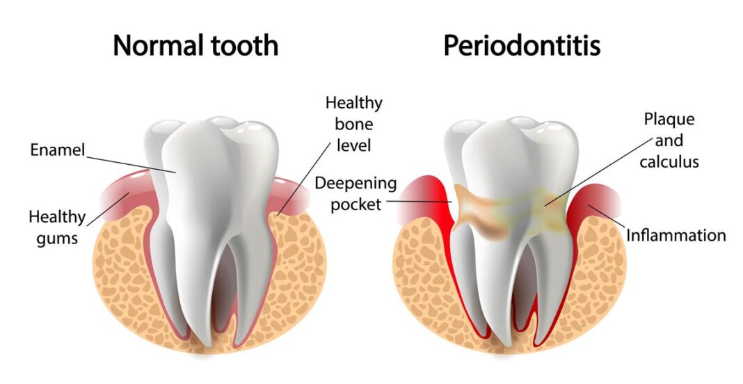 periodontal disease on tooth