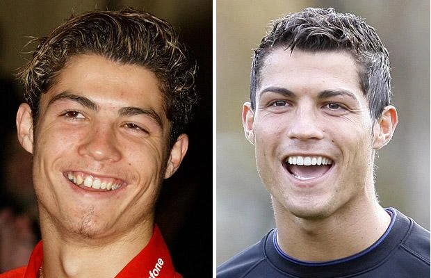 Cristiano Ronaldo Teeth Transformation