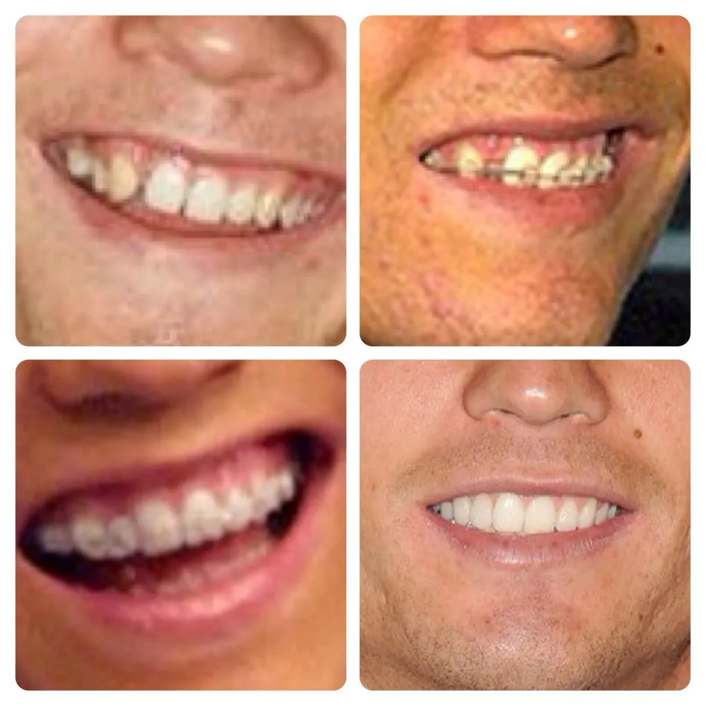 Cristiano-Ronaldo-Teeth-Transformation